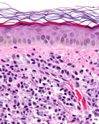 Biopsie kožní mastocytózy
